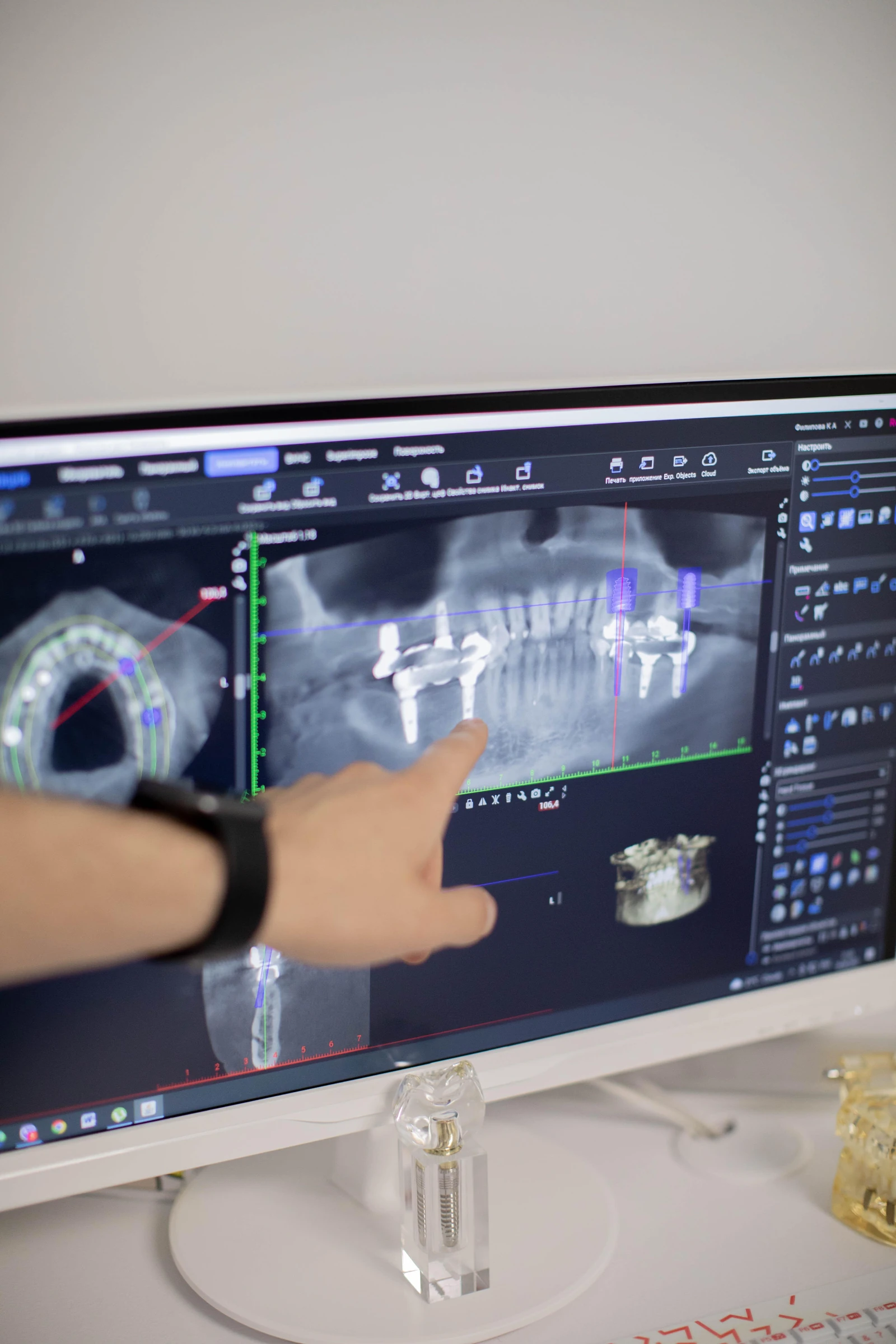 Цифрове планування імплантації за 3D-моделлю щелепи у програмі