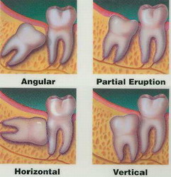 Осложнения после удаления зубов