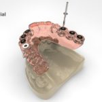 dentalnaya-implantaciya-01