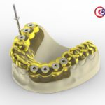 dentalnaya-implantaciya-02
