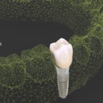 dentalnaya-implantaciya-03