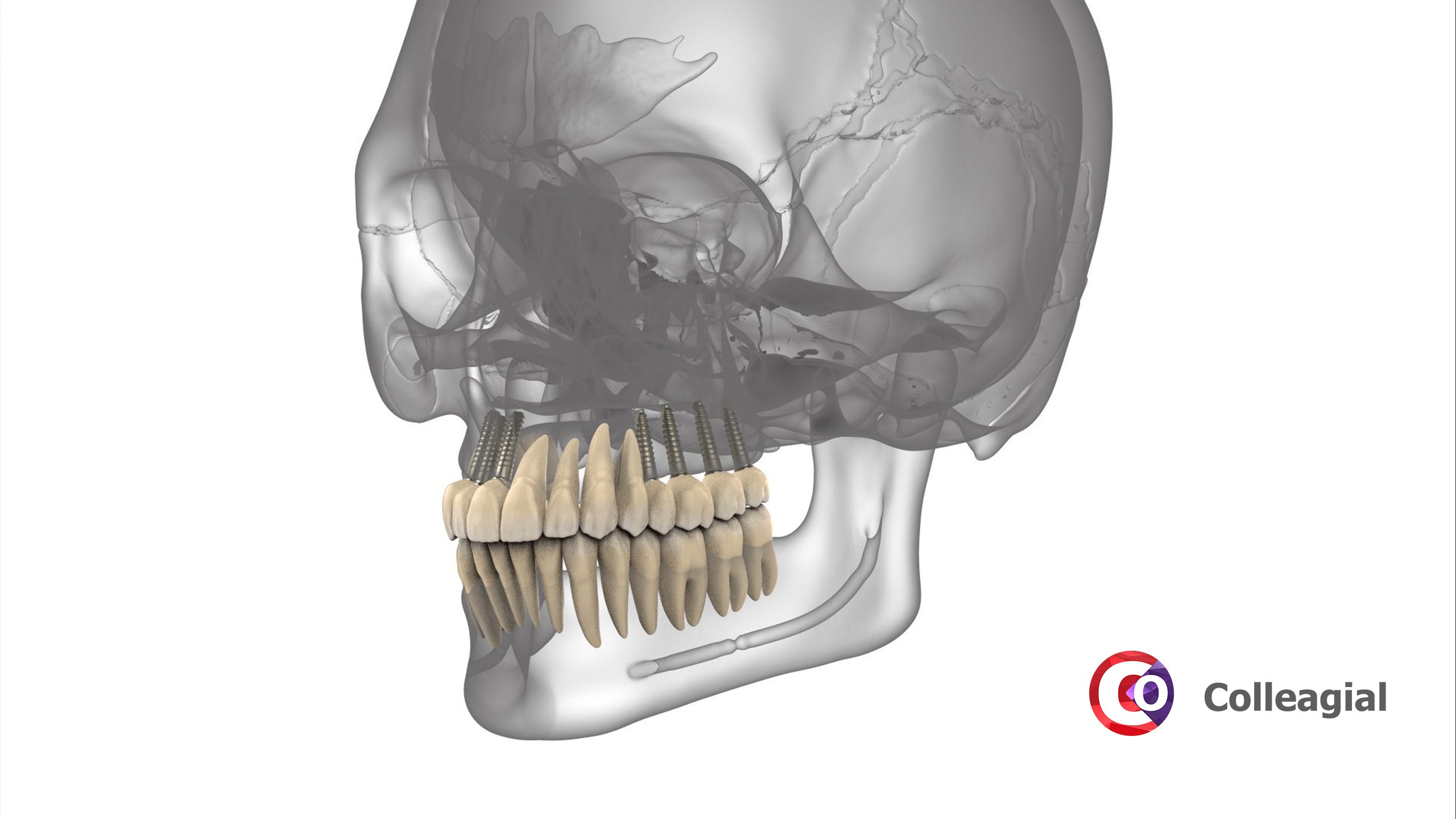 dentalnaya-implantaciya-04