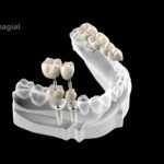 dentalnaya-implantaciya-05
