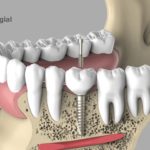 dentalnaya-implantaciya-06