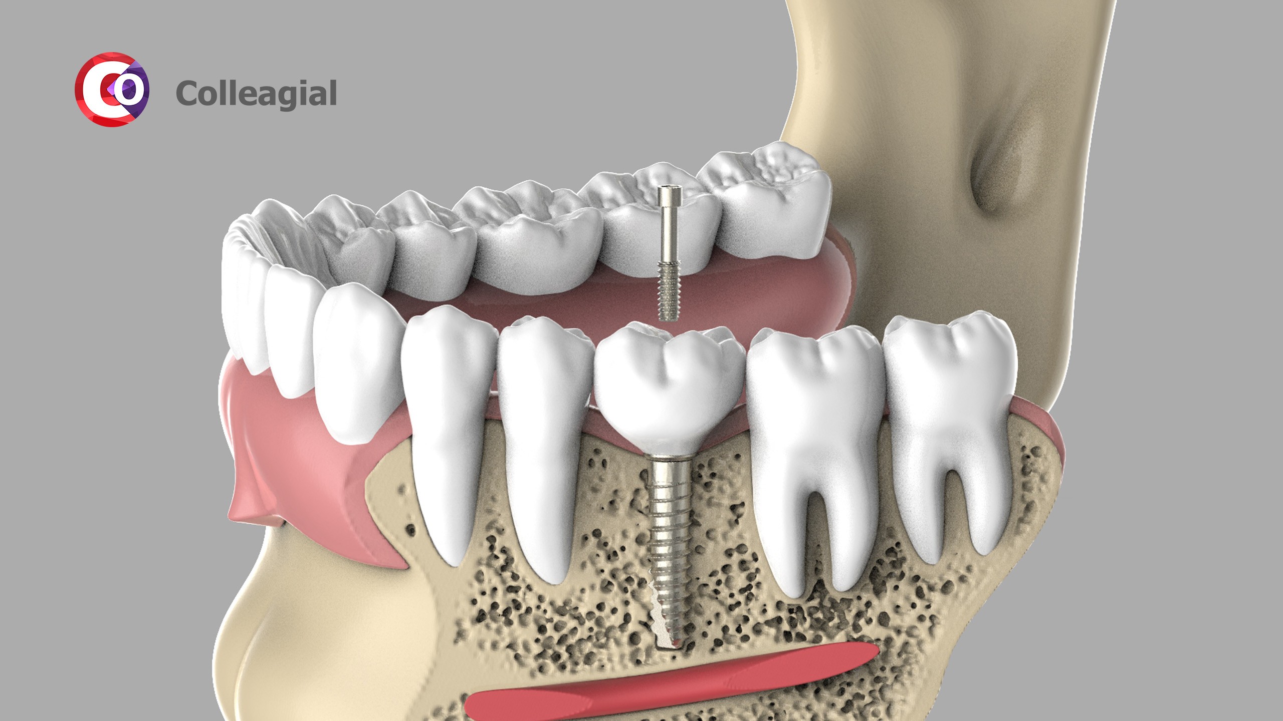 dentalnaya-implantaciya-06