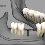 dentalnaya-implantaciya-07