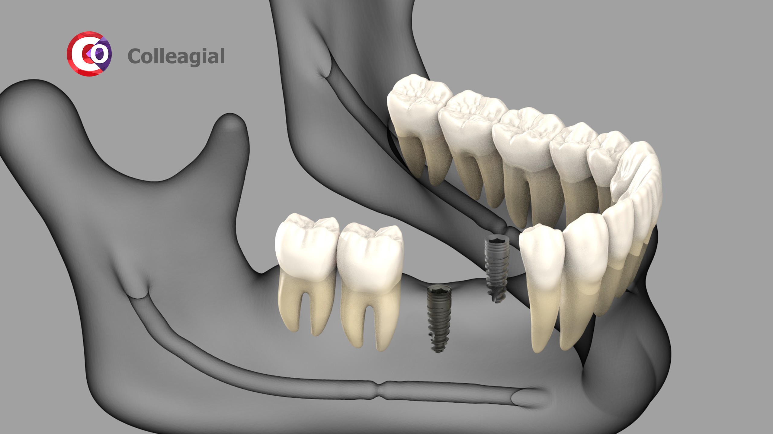 dentalnaya-implantaciya-07