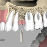dentalnaya-implantaciya-08