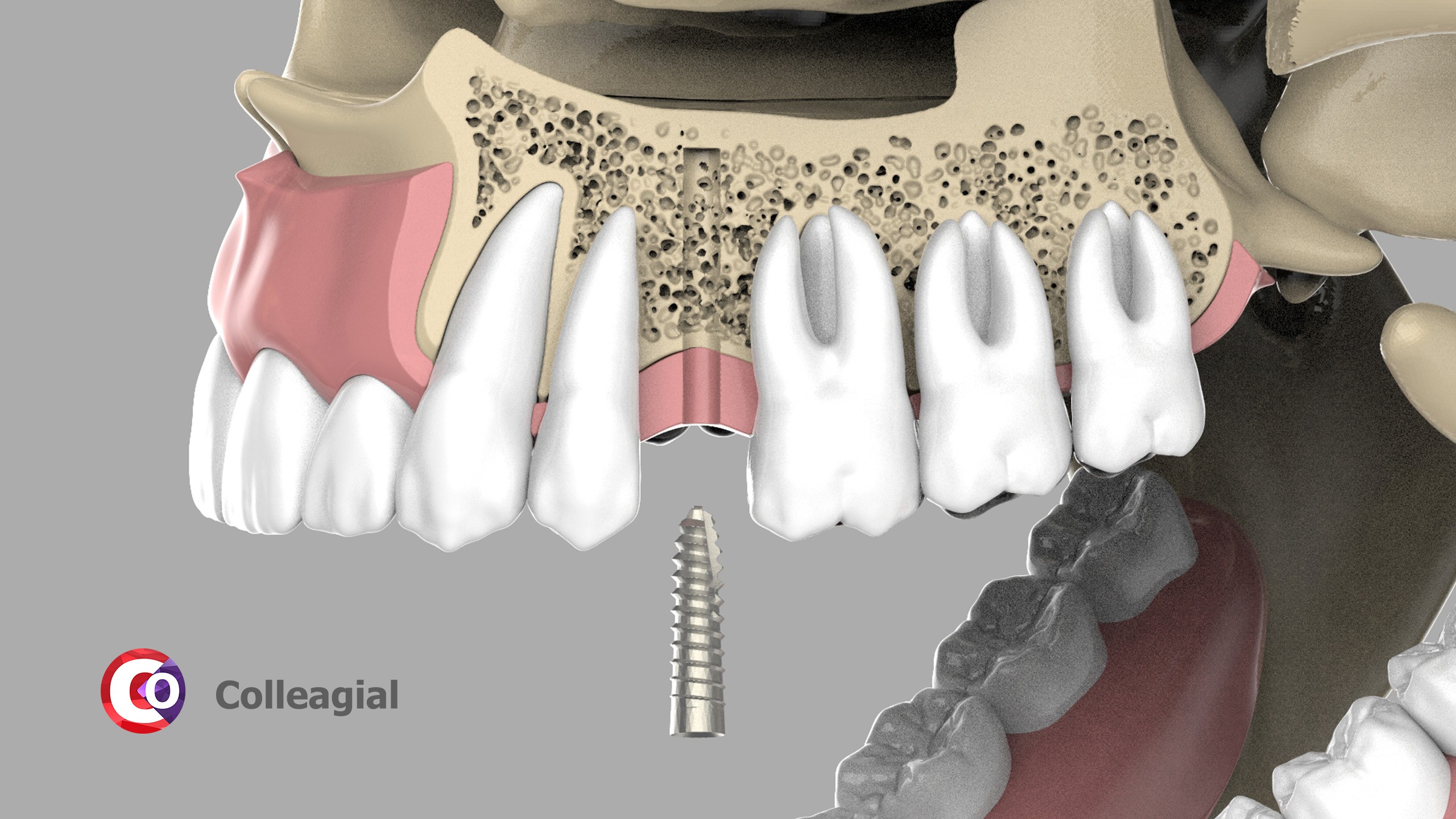 dentalnaya-implantaciya-08