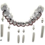 dentalnaya-implantaciya-09