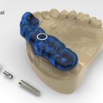dentalnaya-implantaciya-10