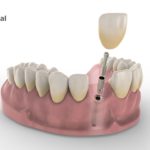 dentalnaya-implantaciya-11
