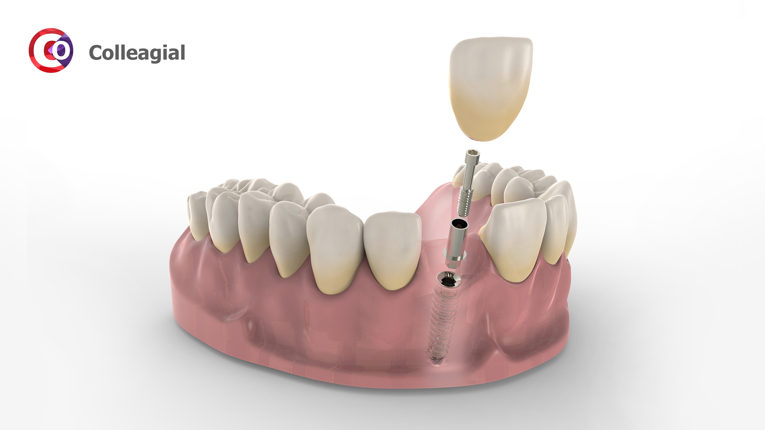 dentalnaya-implantaciya-11