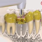 dentalnaya-implantaciya-12