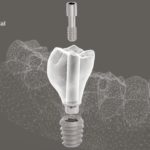 dentalnaya-implantaciya-15