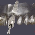 dentalnaya-implantaciya-16