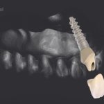 dentalnaya-implantaciya-17