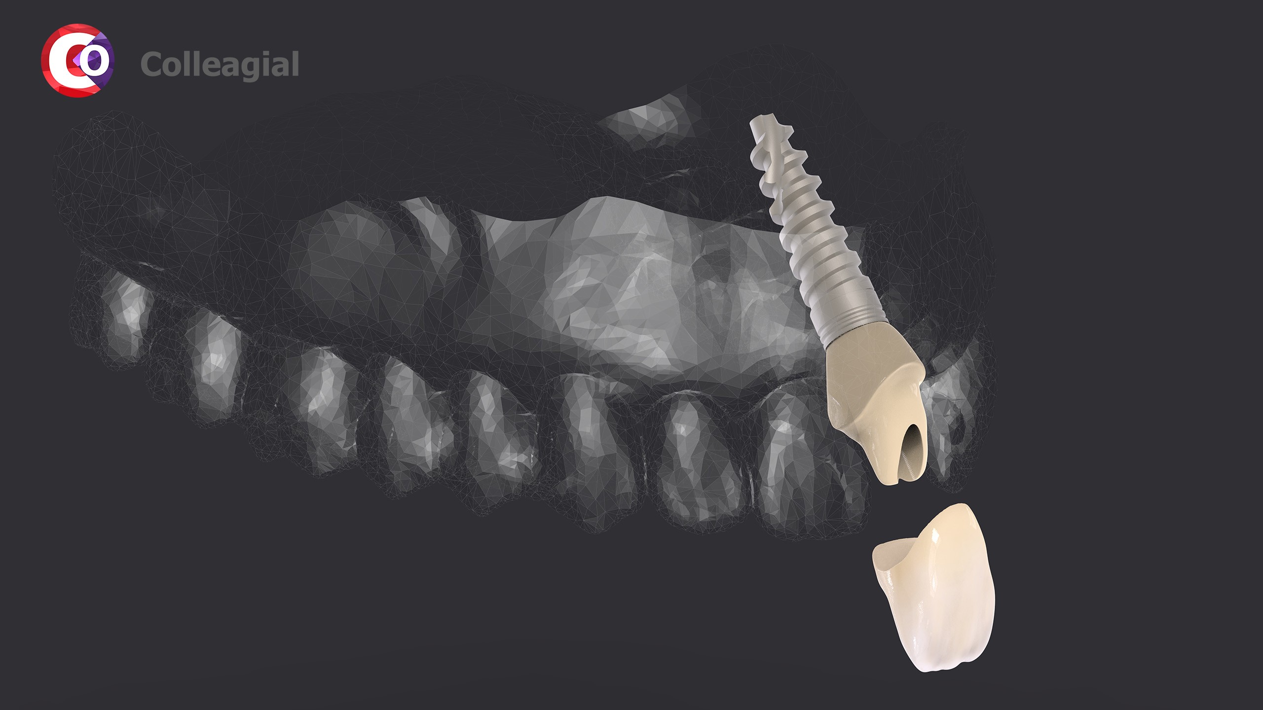dentalnaya-implantaciya-17