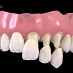 plastikovye-nesemnye-zubnye-protezy-01
