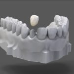 plastikovye-nesemnye-zubnye-protezy-03