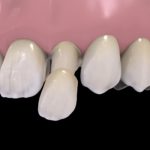 plastikovye-nesemnye-zubnye-protezy-05