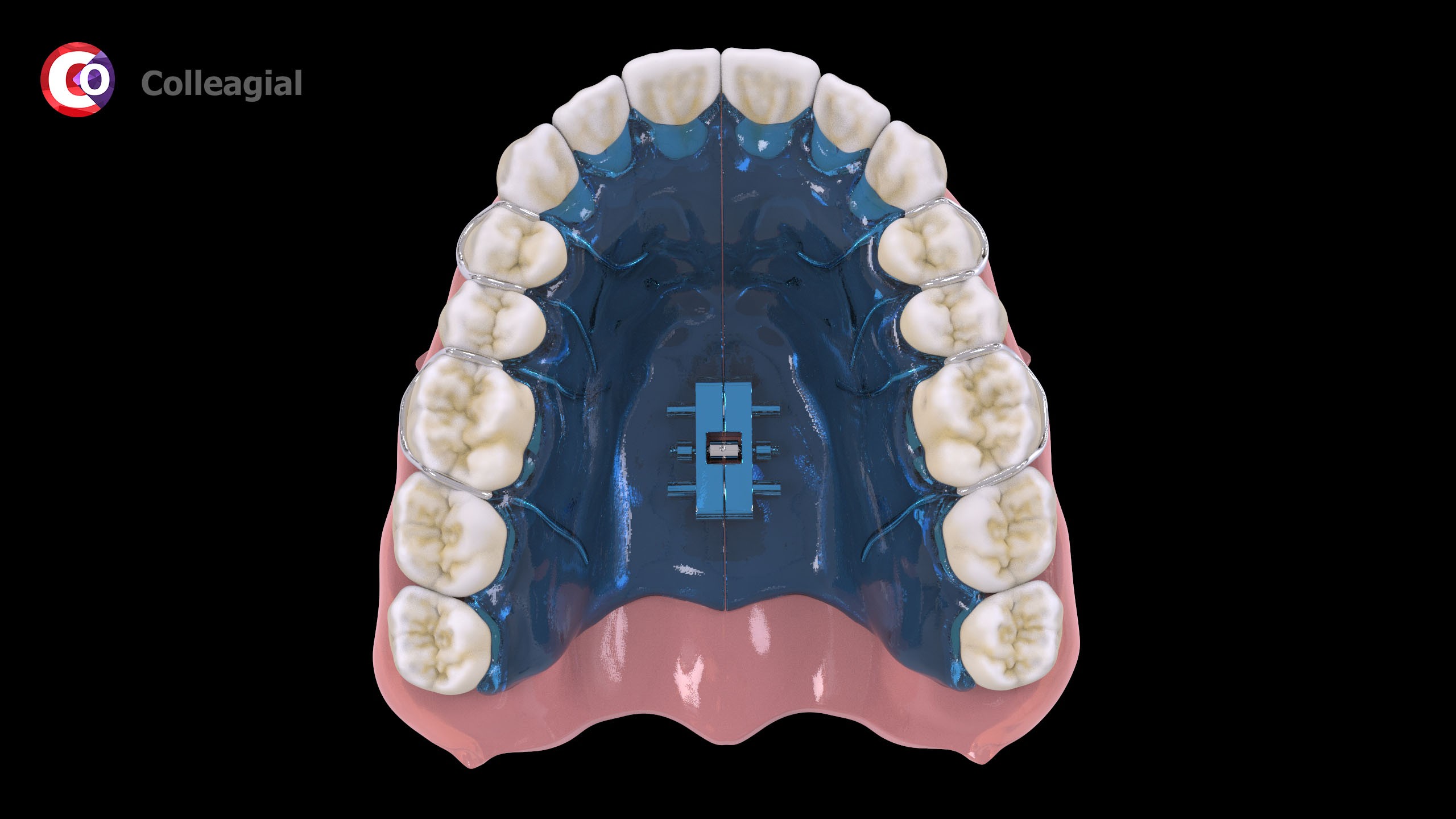 Ortodonticheskie-apparaty-03