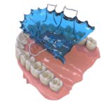 Ortodonticheskie-apparaty-04