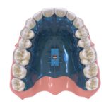 Ortodonticheskie-apparaty-05