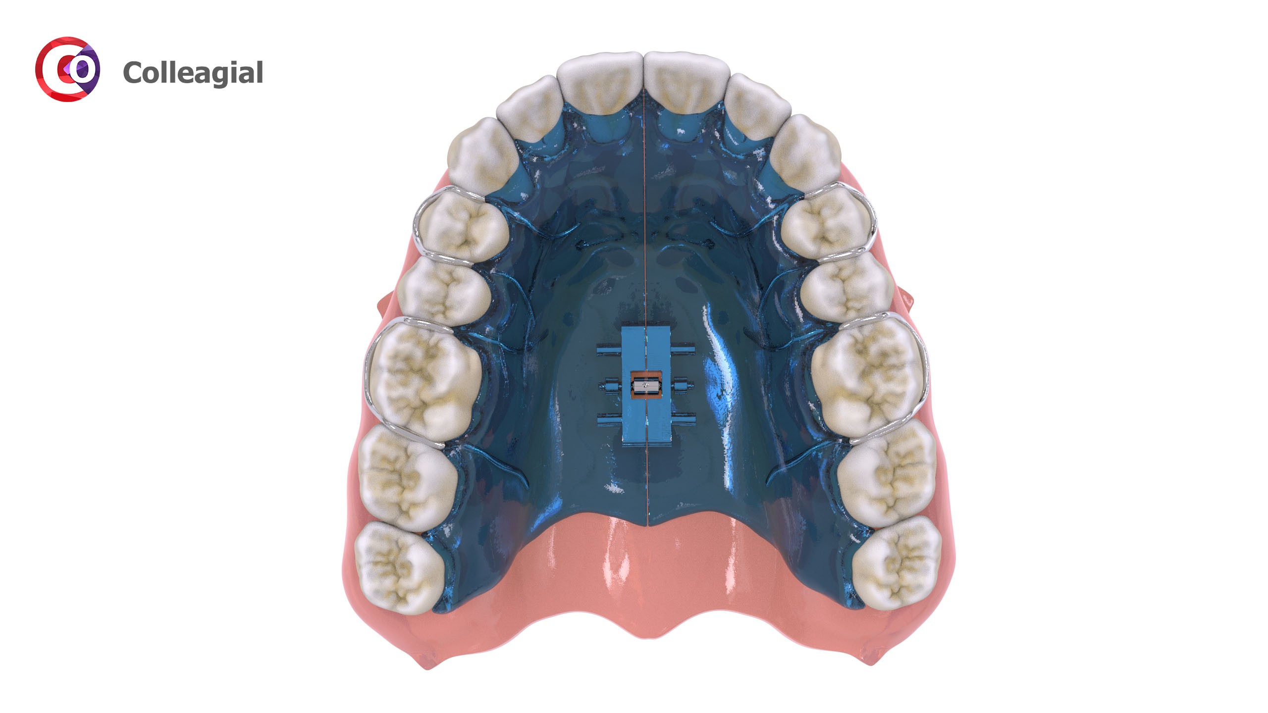Ortodonticheskie-apparaty-05