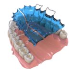 Ortodonticheskie-apparaty-07